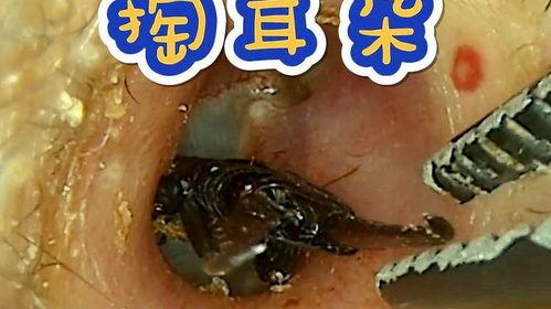 掏耳屎的视频,轻松掌握清洁耳朵小技巧