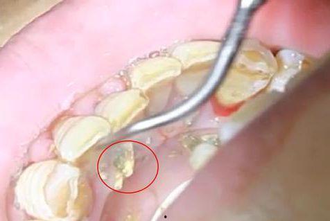 抠牙结石视频,视频教你轻松抠牙垢