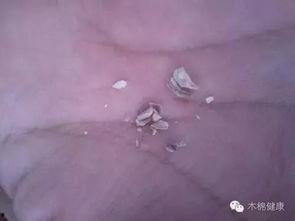 抠牙结石视频,视频教你轻松抠牙垢
