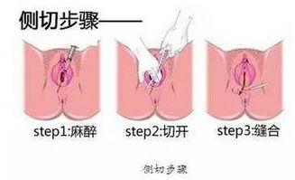 真人分娩侧切缝合视频,专业视角下的护理瞬间